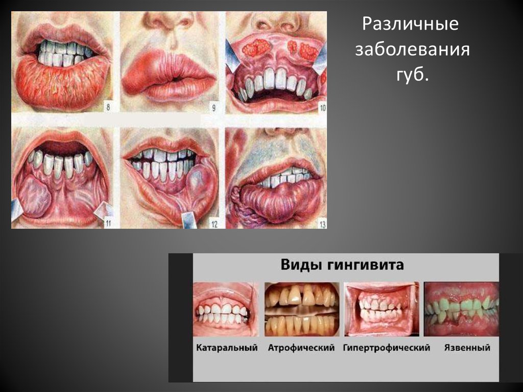 Различные заболевания губ.