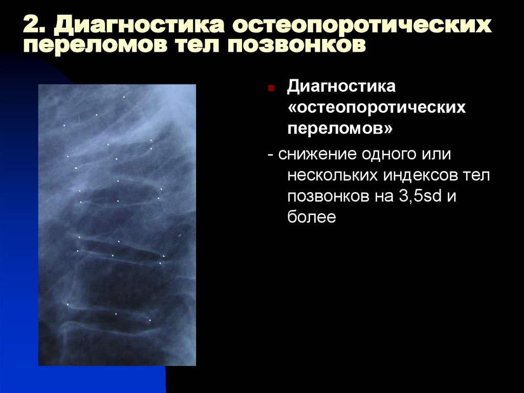 Перелом позвоночника тесты с ответами. Морфометрия позвоночника. Остеопоротические переломы. Костная морфометрия. Морфометрия в гистологии.