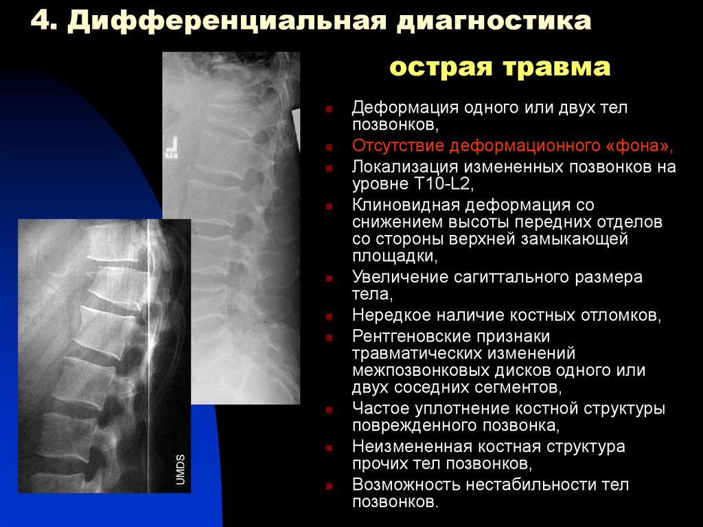 Дегенеративный отек костного мозга