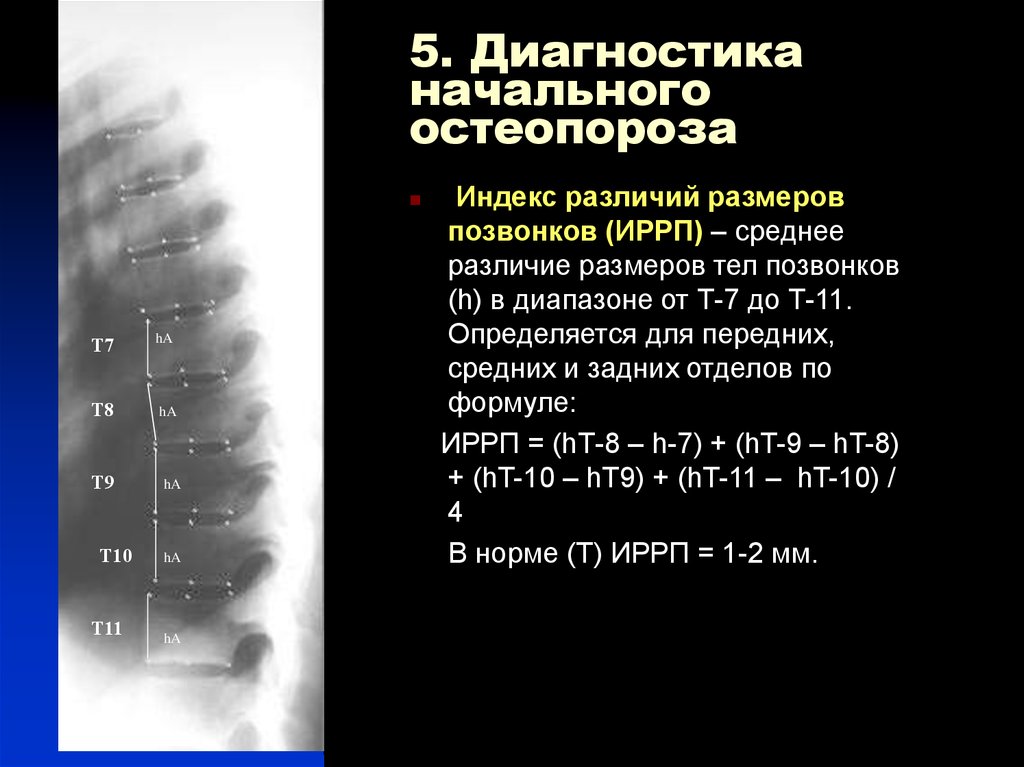 Начальный диагноз. Остеопороз позвоночника рентген симптомы. Рентген признаки остеопороза позвоночника. Остеопороз рентген признаки. Рентгенологичесике признаки остеопроз.