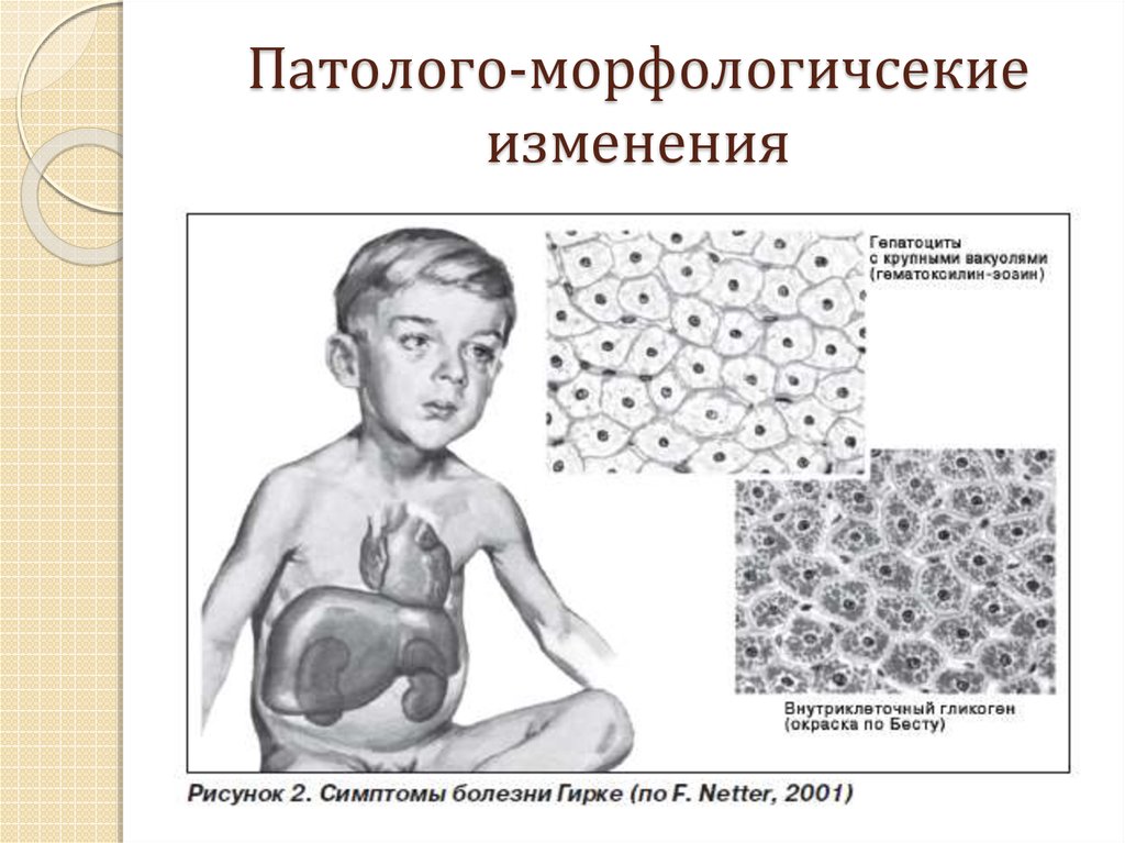 Болезнь помпе картинки