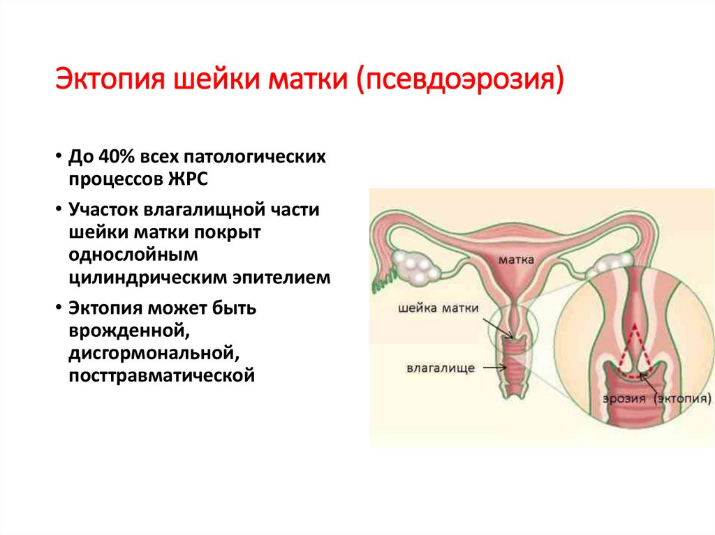 Эктопия шейки матки что это. Шейка матки эктопированная.