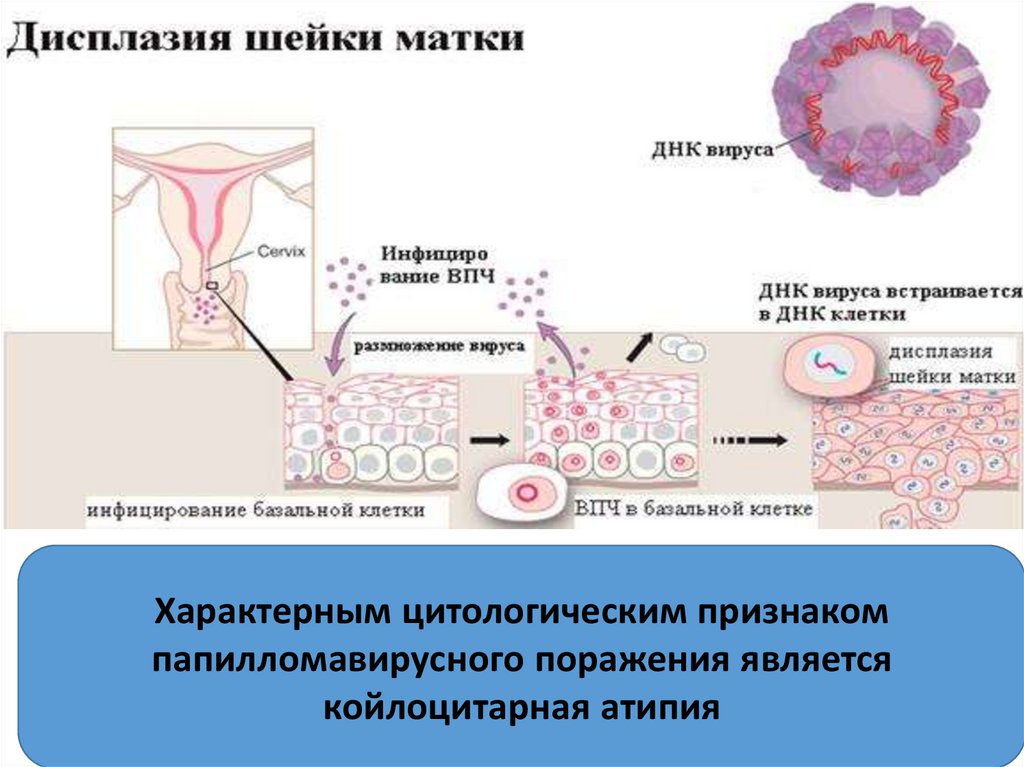 Лечение дисплазии шейки матки 1 степени