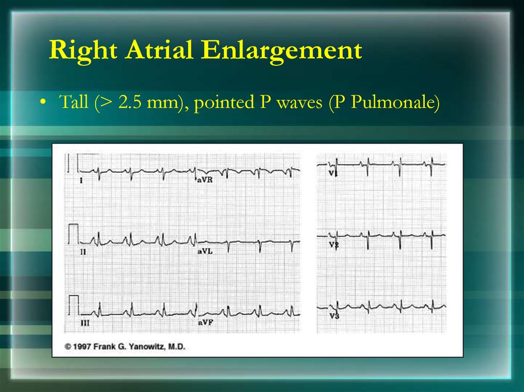 basics-of-ecg-online-presentation