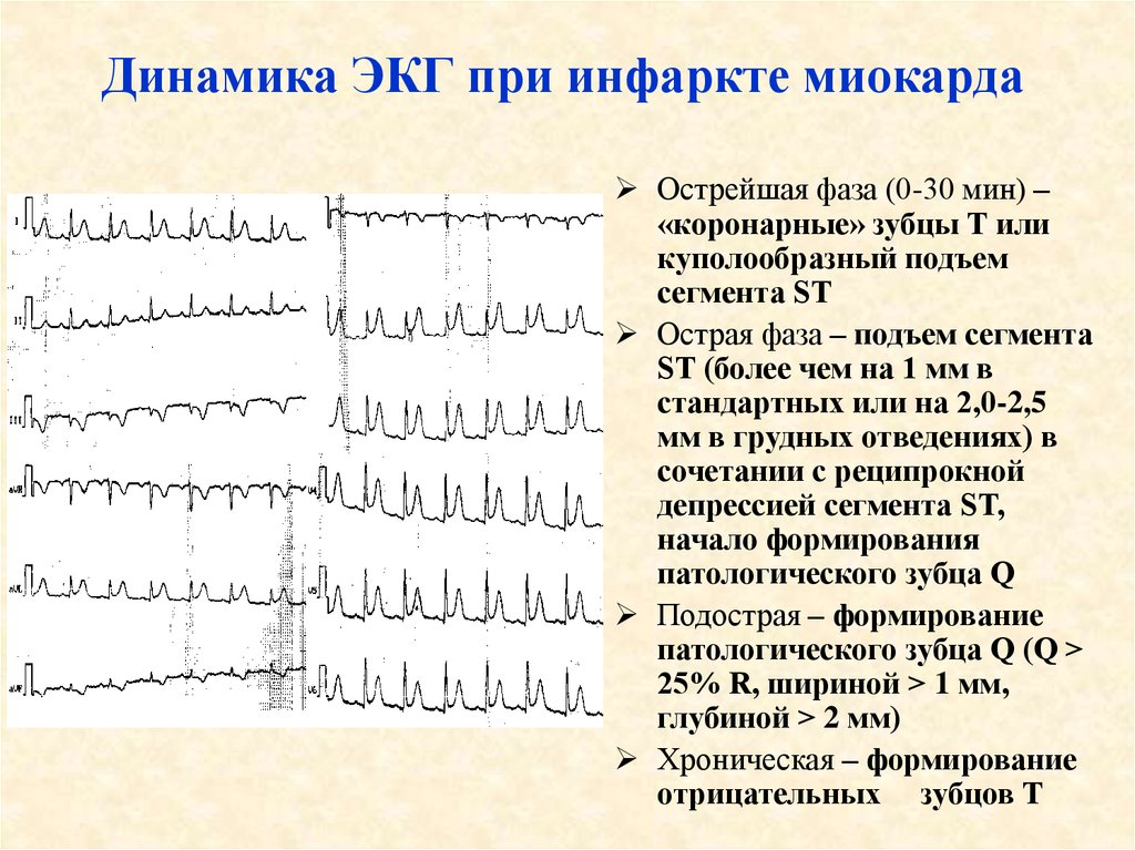Изменения миокарда умеренные на экг что значит. ЭКГ заключение инфаркт миокарда. Переднеперегородочный инфаркт миокарда на ЭКГ. Инфаркт миокарда изменения на ЭКГ. Результаты ЭКГ при инфаркте миокарда.
