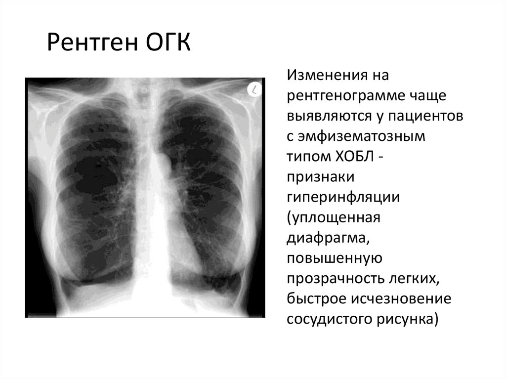 Хобл рентген картина