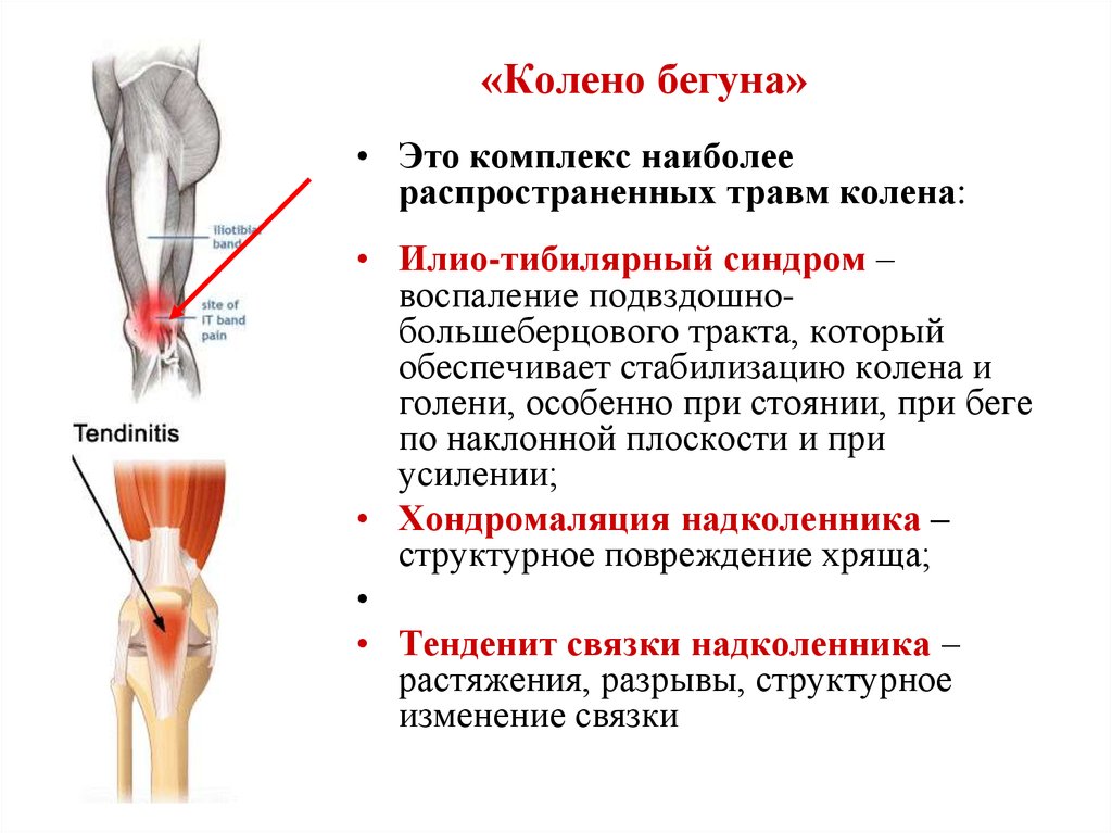 После бега болят колени что делать. Илиотибиальный тракт синдром. Синдром илиотибиального тракта колена. Синдром бегуна колено илиотибиального тракта. Колено бегуна.