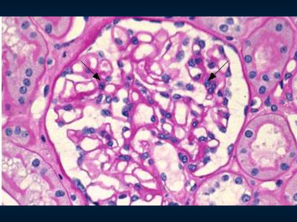 Острый гломерулонефрит микроскопическая картина
