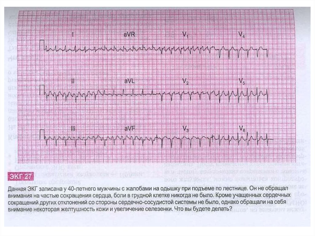 Экг после. Атлас ЭКГ. Кардиограмма при остеохондрозе. ЭКГ методическое пособие. ЭКГ С ответами.