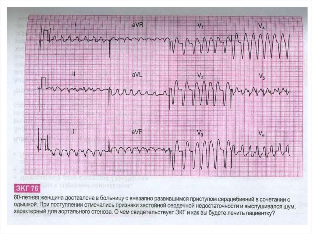 Патологии на экг фото с расшифровкой примеры