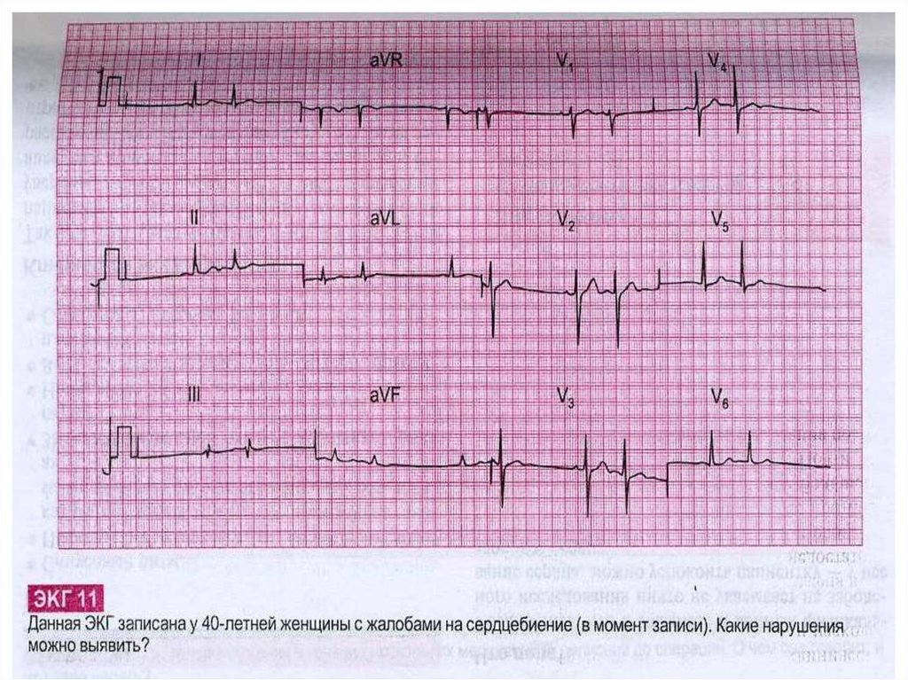 Экг человека. Синдром Фредерика на ЭКГ. Синдром Фредерика ЭКГ расшифровка. Нарушение ритма на ЭКГ подъем St.