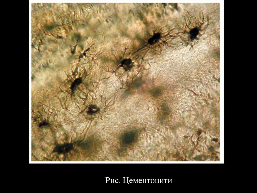 Цемент корень. Клеточный и бесклеточный цемент зуба гистология. Клеточный цемент гистология. Препарат клеточный цемент цементоциты гистология. Цемент корня зуба гистология.