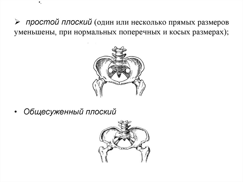 Презентация аномалии костного таза