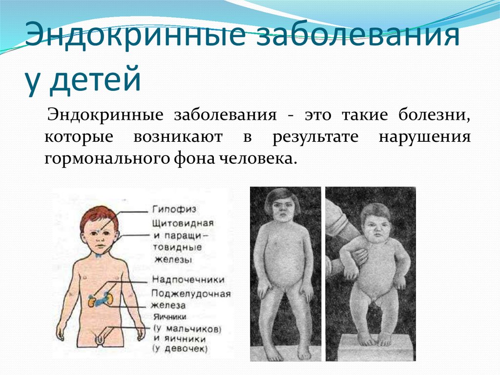 Болезни эндокринной системы у детей презентации thumbnail