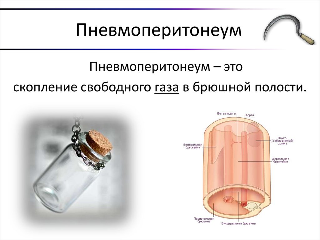 Пневмоперитонеум