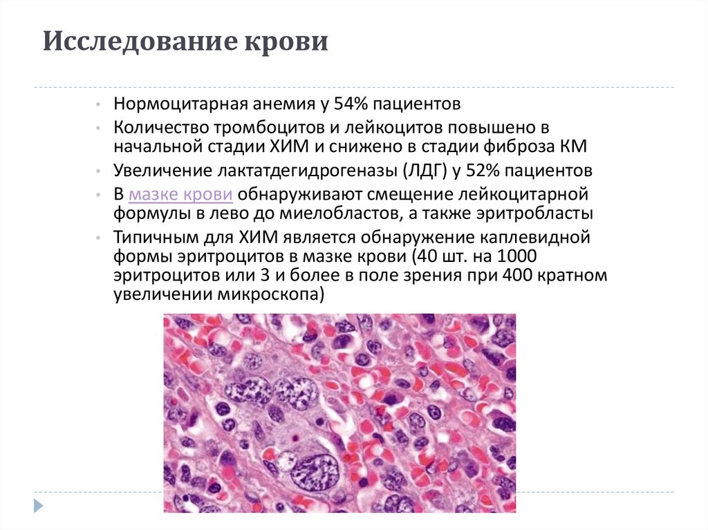 Картина крови при туберкулезе