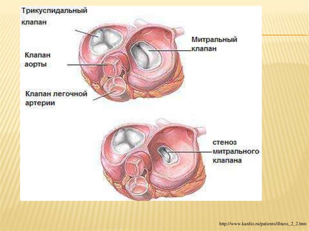 Митральный аортальный стеноз. Стеноз митрального и аортального клапана. Митральный стеноз эндокардит. Приобретенные пороки митрального клапана. Приобретенные пороки сердца митральный стеноз.