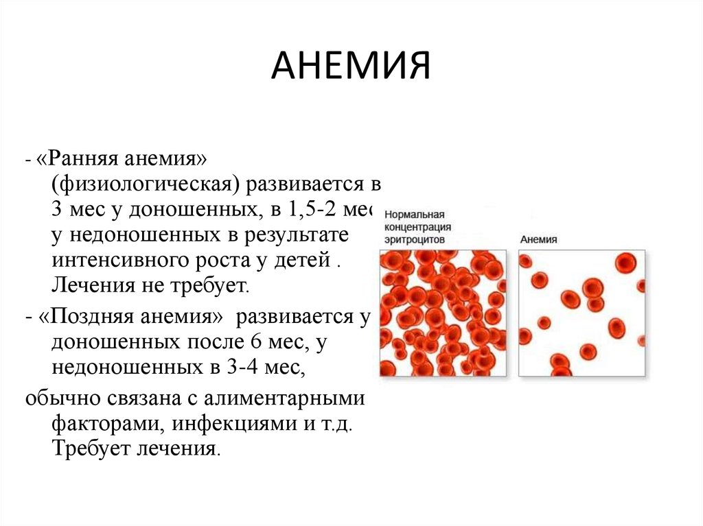 Анемия крови что это. Анемия кратко. Ранняя анемия.