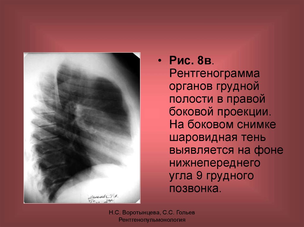 Рентгенограмма в боковой проекции. Рентгенограмма грудной клетки в боковой проекции. Рентген грудины в боковой проекции. Рентгенограмма грудной клетки в правой боковой проекции. Рентгенограмма ОГК В боковой проекции.