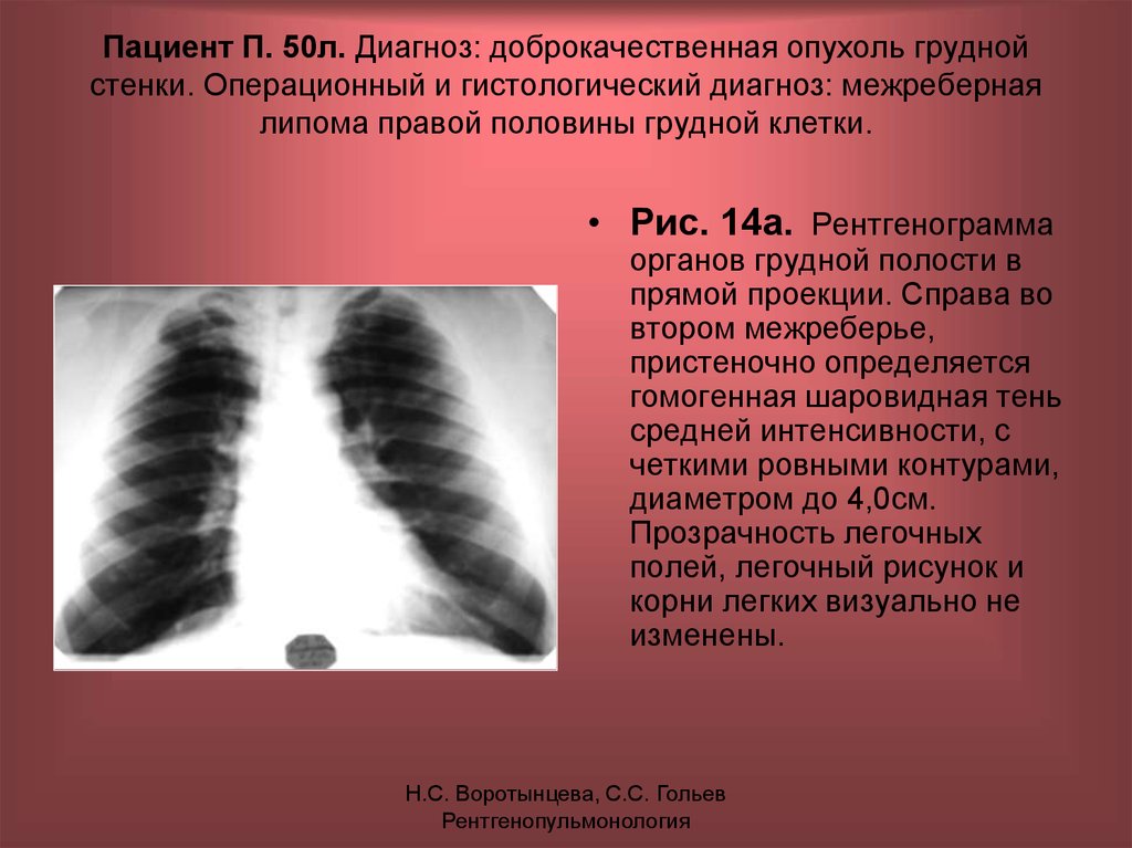 Тени средней интенсивности в легком