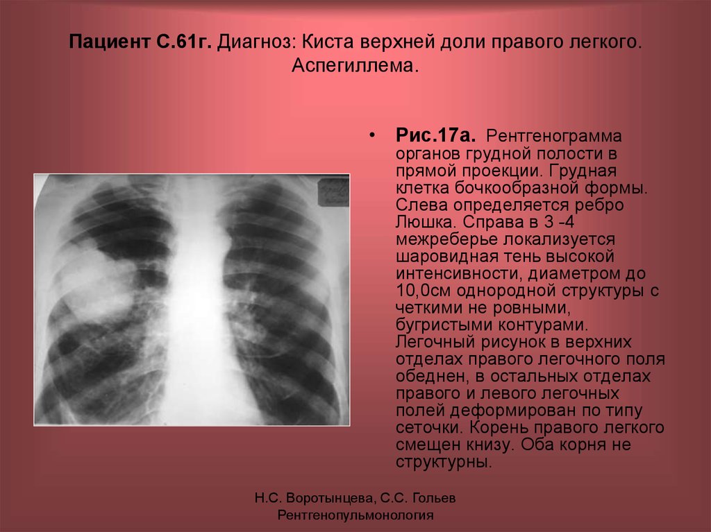 Диагноз г 5. Рентгенограмма органов грудной полости. Образование верхней доли правого легкого. Обзорной рентгенограмме органов грудной полости. Киста верхней доли правого лёгкого.
