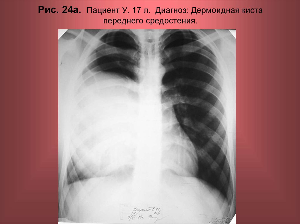 Л диагноз. Дермоидные кисты средостения рентген. Дермоидная киста средостения кт. Тератома переднего средостения. Дермоидная киста рентген.