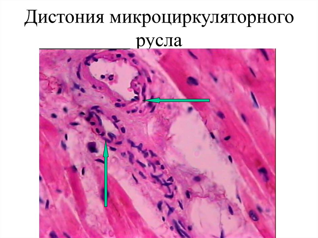 Дистония микроциркуляторного русла