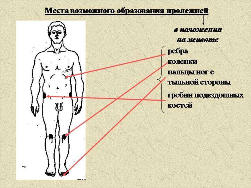 Места образования пролежней схема