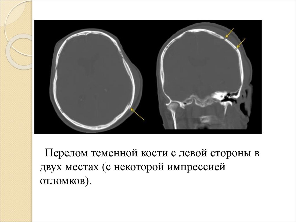 Линейная трещина. Вдавленный перелом теменной кости кт. Перелом теменной кости черепа рентген. Перелом затылочной кости кт. Импрессионный перелом свода черепа.