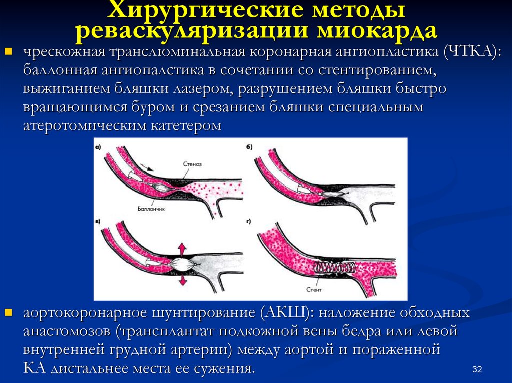 Транслюминальная ангиопластика. Хирургические методы реваскуляризации миокарда. Эндоваскулярная реваскуляризация миокарда. ТРАНСЛЮМИНАЛЬНАЯ коронарная ангиопластика. Хирургический метод реваскуляризации миокарда.