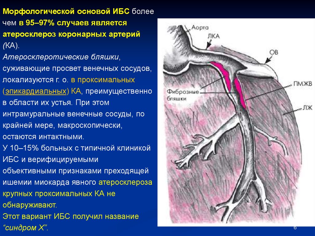 Ишемия латынь. Атеросклероз коронарных артерий сосуды. ИБС атеросклероз коронарных артерий. Атеросклероз венечных артерий. Атеросклероз венечных артерий сердца.