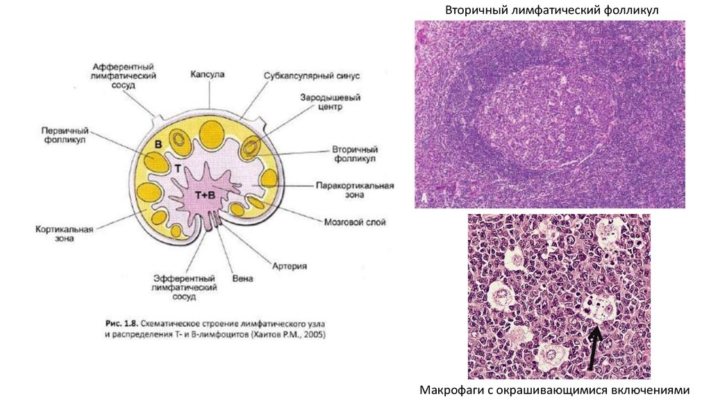 Лимфоидные фолликулы. Первичные лимфатические фолликулы. Первичные и вторичные лимфоидные узелки. Строение вторичного лимфоидного узелка. Морфология неопухолевых лимфаденопатий.