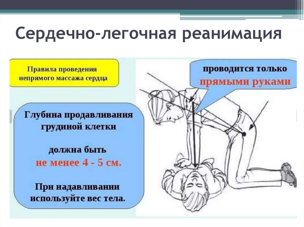 Сердечно легочную реанимацию начинают