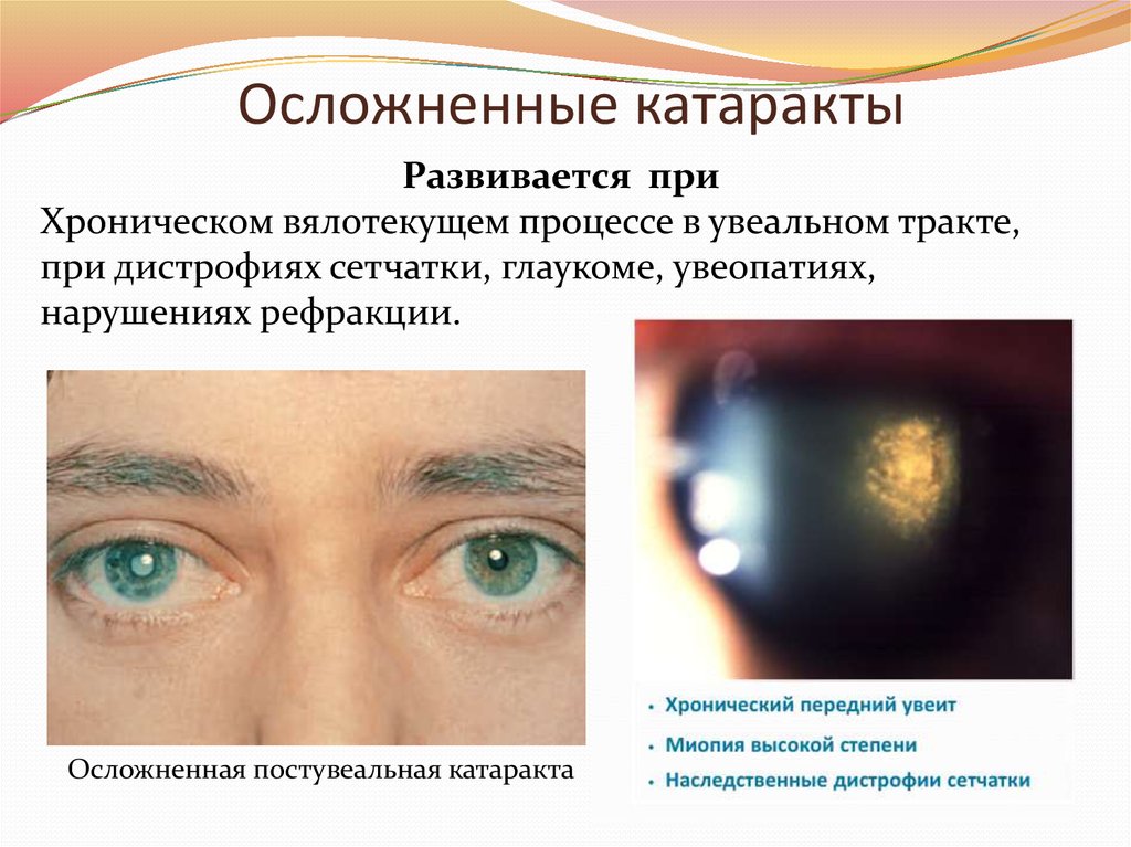 Заболевания и повреждения глаз. Осложненная катаракта. Катаракта глаза симптомы. Осложненная увеальная катаракта.