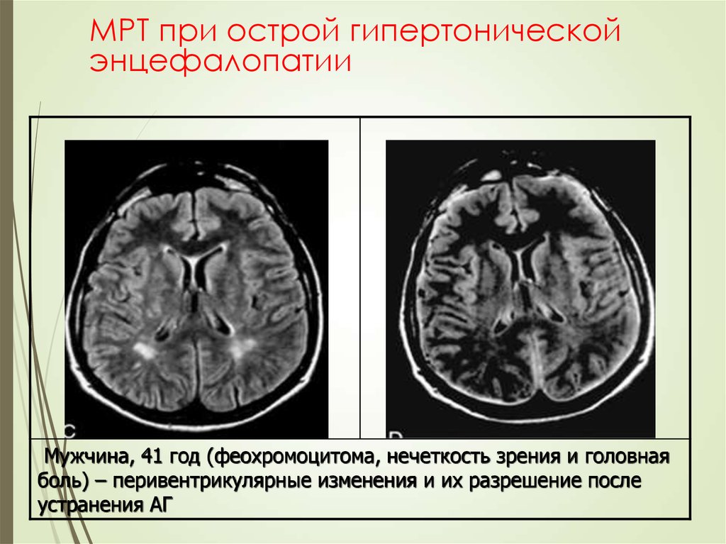 Резидуальные изменения головного мозга. Острая почечная гипертензионная энцефалопатия. Острая гипертоническая энцефалопатия мрт. Энцефалопатия гипертонического генеза. Острая некротизирующая энцефалопатия мрт.