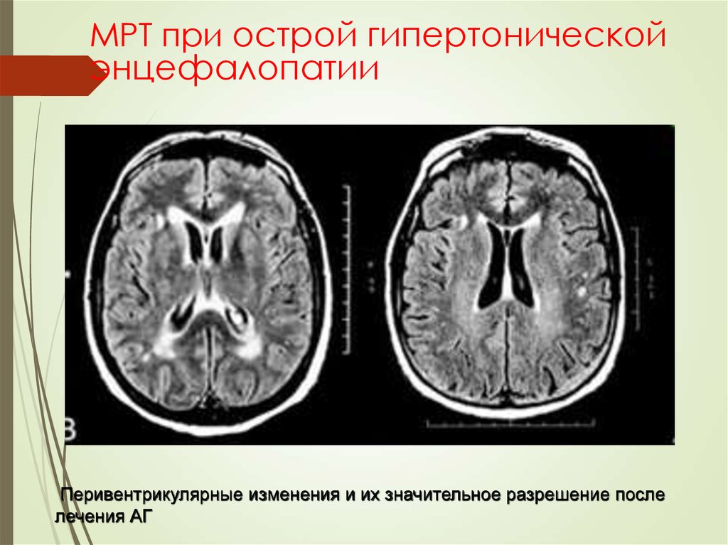Энцефалопатия мозга 2 степени