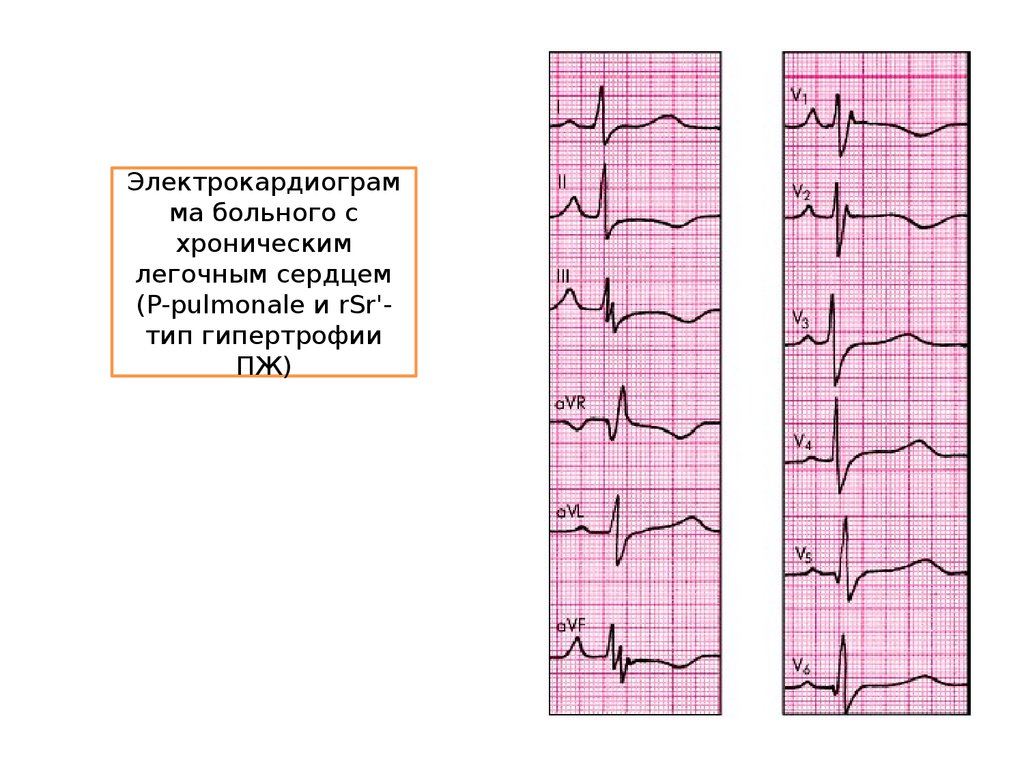 Легочное сердце тесты. Признаки острого легочного сердца на ЭКГ. Легочное сердце характер гемодинамических нарушений. ЭКГ признаки хронического легочного сердца. Аускультация при ХЛС.