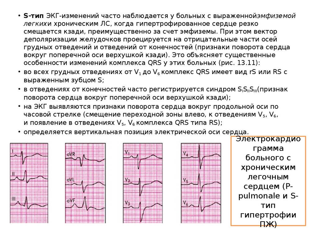 Поворот сердца правым желудочком вперед что это. S Тип ЭКГ. S1 s2 s3 Тип ЭКГ. S Тип ЭОС на ЭКГ. S Тип гипертрофии правого желудочка на ЭКГ.