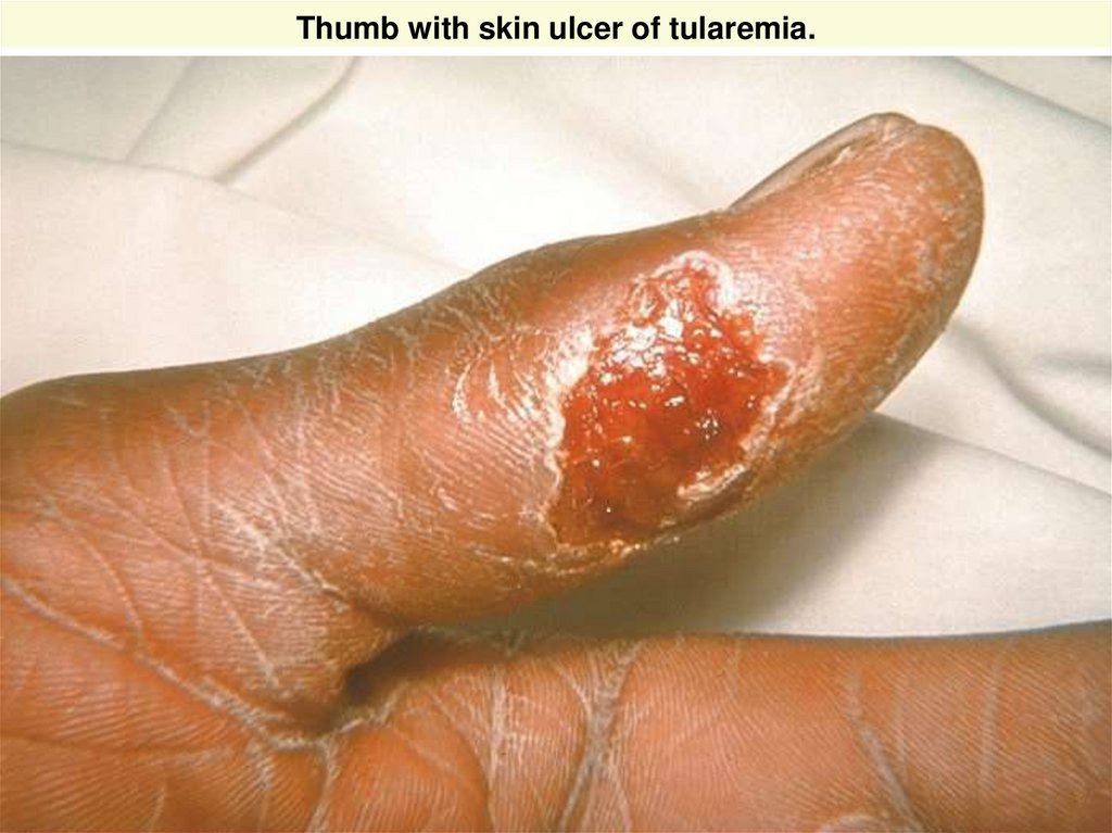 Thumb with skin ulcer of tularemia.
