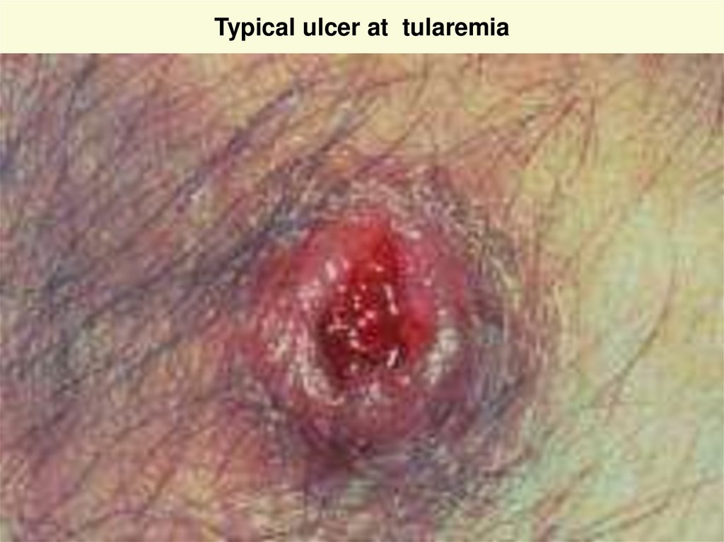 Typical ulcer at tularemia