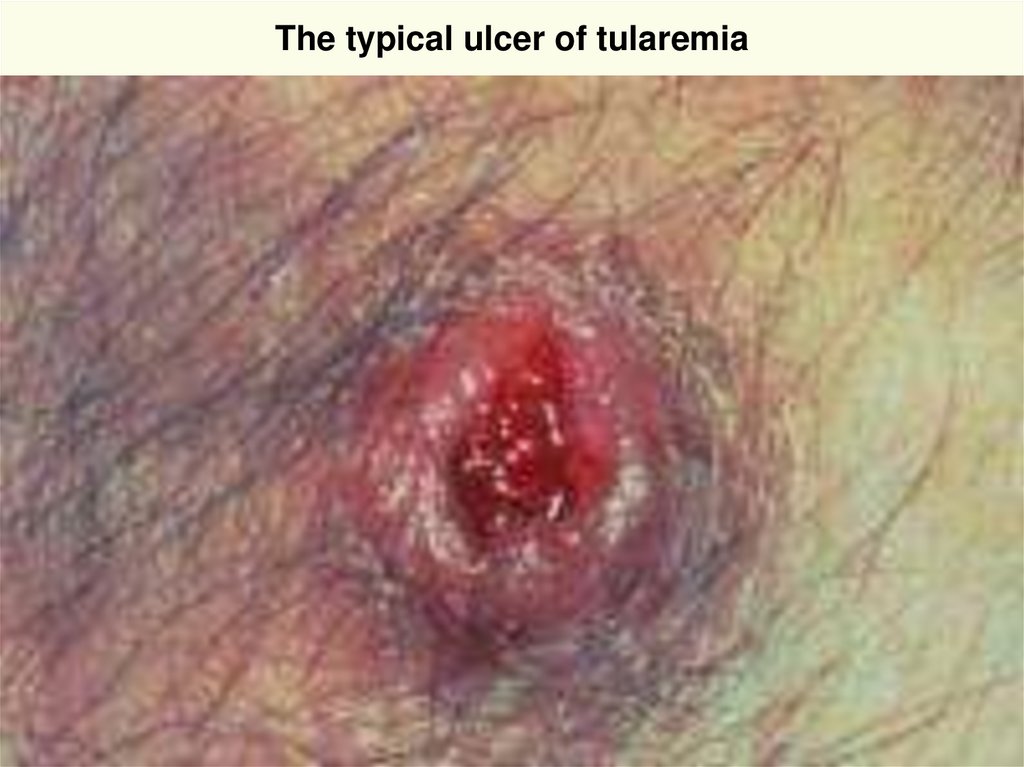 The typical ulcer of tularemia