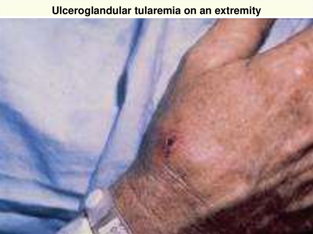 Ulceroglandular tularemia on an extremity