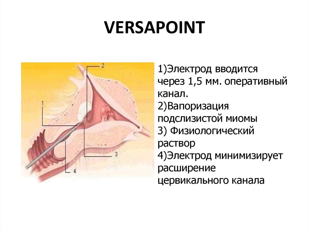 Оперативный канал. VERSAPOINT 2. Доступы в гинекологических операциях. Оперативные доступы при гинекологических операциях.