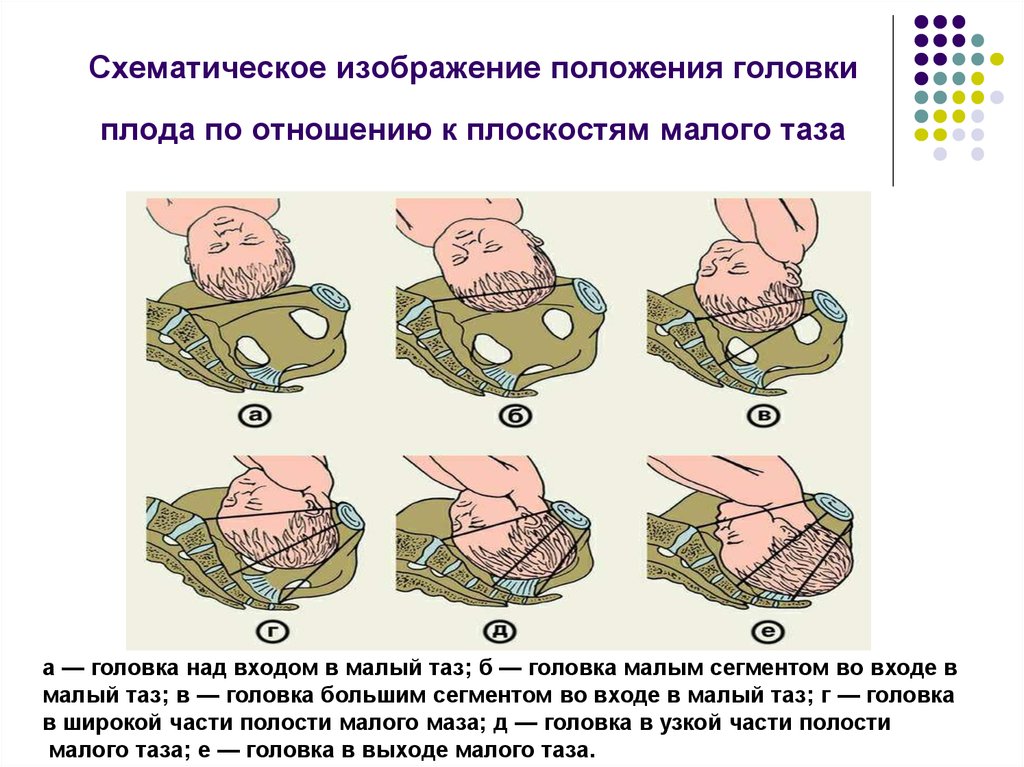 Положение родов. В какой плоскости малого таза находится головка плода. Отношение головки плода к плоскостям малого таза. Как определяется отношение головки плода к плоскости входа малый таз. Определение отношения головки плода к плоскостям таза.