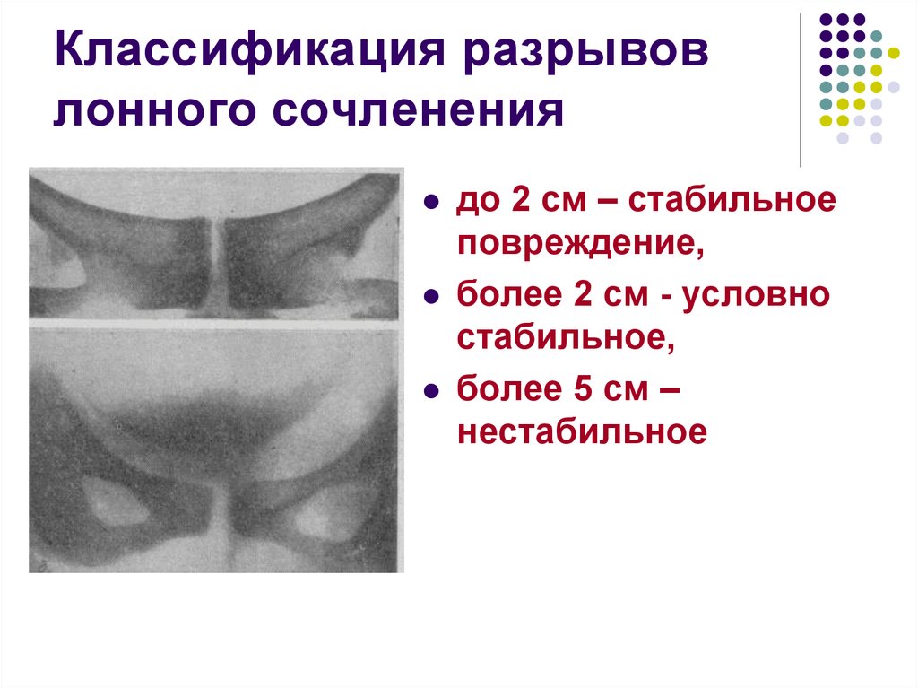 Узи лонного. Акушерский травматизм разрыв лонного сочленения. Разрыв лунного сочинения. Расхождение лонного сочленения УЗИ.