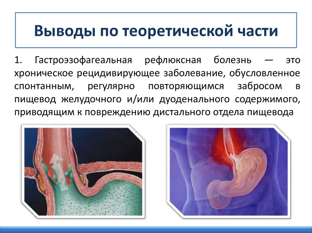 Рефлюксная болезнь желудка