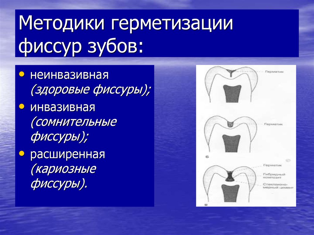 Профилактика герметизация фиссур