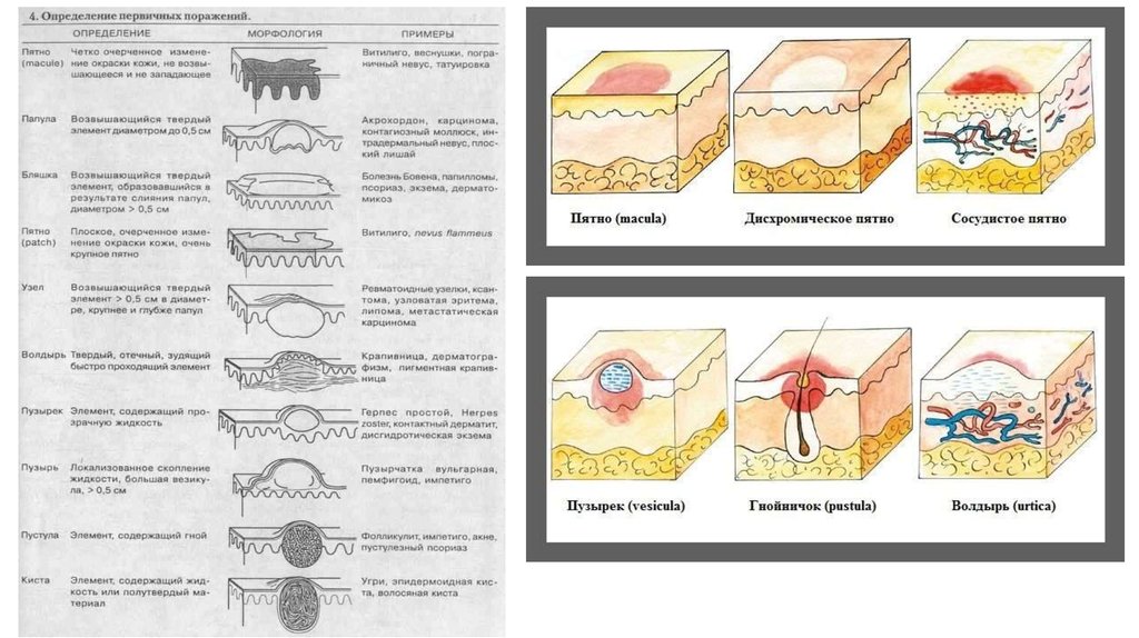 Пятно элемент сыпи. Морфологические элементы сыпи папула. Вторичные морфологические элементы кожи Дерматовенерология. Морфологические элементы кожных сыпей папула. Вторичные морфологические элементы кожных высыпаний.