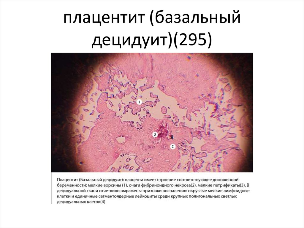 Патология плаценты презентация