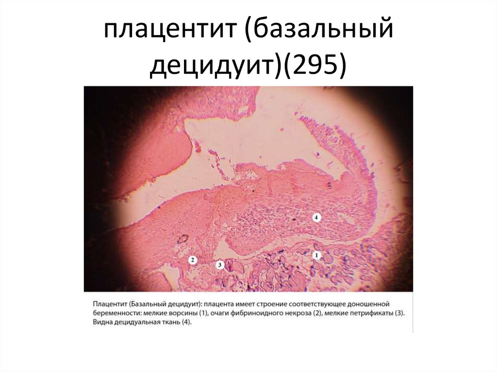 плацентит (базальный децидуит)(295)